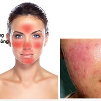 Cảnh Báo Điều trị Mụn không đúng Cách