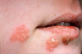 herpes là gì