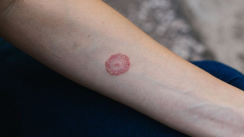 HẮC LÀO LÂY KHÔNG