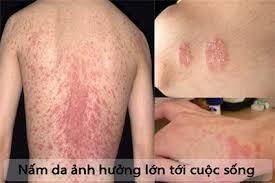 benh nấm da