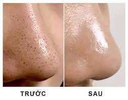 cách trị mụn đầu đen
