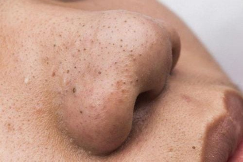 cách trị mụn đầu đen