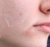 NGĂN NGỪA NỔI MỤN