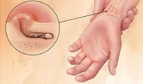 hình ảnh bệnh ghẻ ngứa