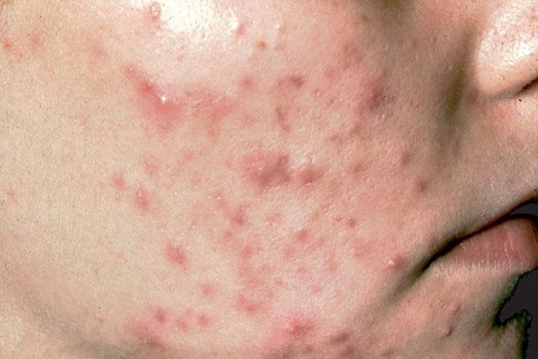 MỤN TRỨNG CÁ DAI DẲNG ĐIỀU TRỊ CHUẨN Y KHOA BẰNG LASER