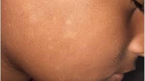 lang ben ở trẻ em