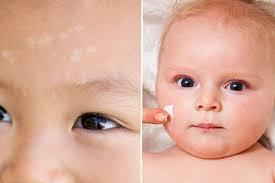 lang ben ở trẻ em