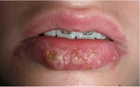 herpes