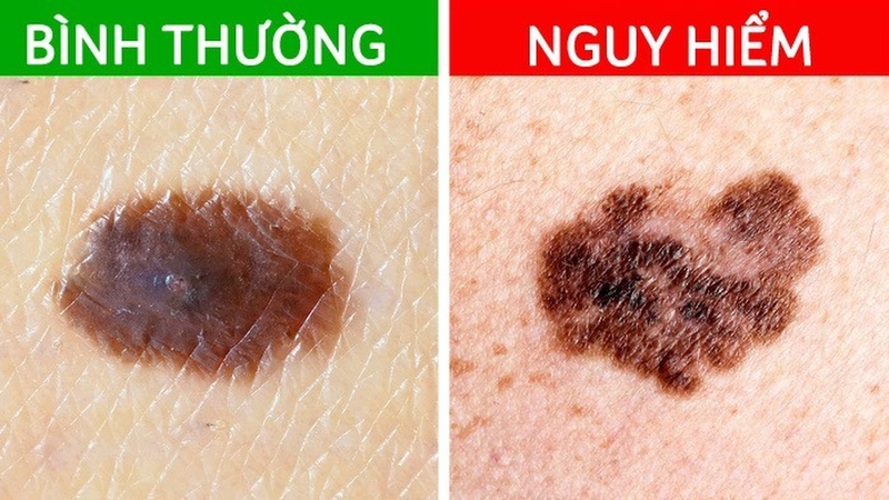 nốt ruồi