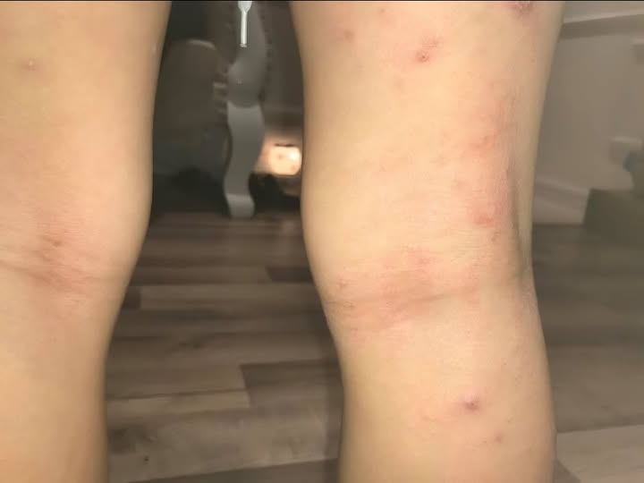 u mềm lây ở trẻ