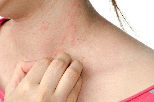 viêm da dị ứng
