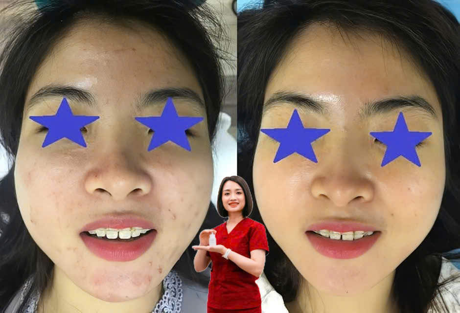 ẢNH ĐIỀU TRỊ MỤN CHUẨN Y KHOA SAU LASER
