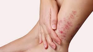 Cảnh báo 5 Bệnh Da Liễu Thường Gặp Mùa Mưa Lũ