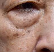 Đồi Mồi Trên Da: Nguyên Nhân Và Cách Trị Hiệu Quả