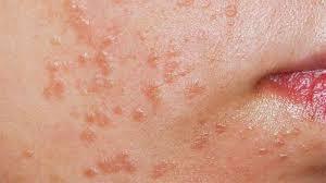 Mụn Hạt Cơm, Hạt Cơm Phẳng: Nguyên Nhân Và Cách Trị
