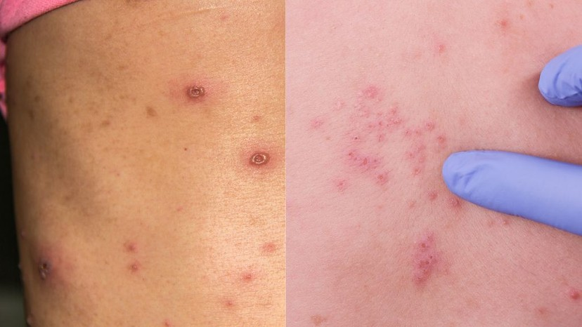 Hình Ảnh Bệnh Thủy Đậu Ở Người Lớn Qua Từng Giai Đoạn – Cách Điều Trị