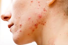 7 Thói Quen Khiến Da Nổi Mụn Và Lão Hóa Nhanh – Bác Sĩ Hiền Giải Thích