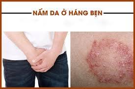 Nấm Bẹn Là Gì? Cách Trị Nấm Da Bẹn Nhất là Trong Mùa Bão Lũ