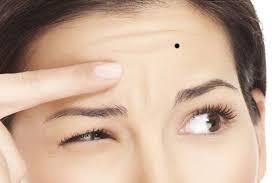 Nốt Ruồi: Nguyên Nhân, Cách Phân Loại Và Khi Nào Xóa