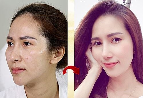 Tiêm Filler Có Hại Về Sau Không?