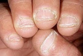 cách trị nấm móng