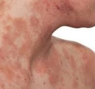 hình ảnh viêm da cơ địa người lớn