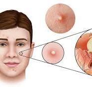 hình ảnh mụn nhọt