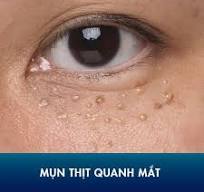 mụn thịt là gì