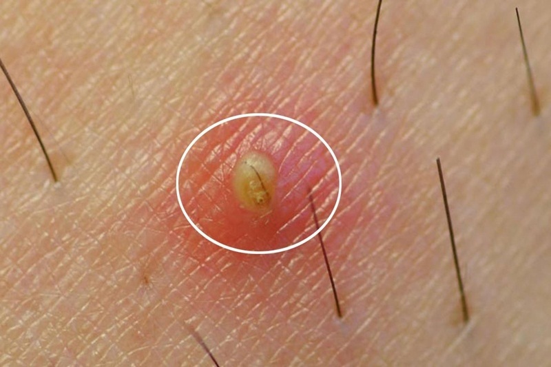 mụn nhọt là gì