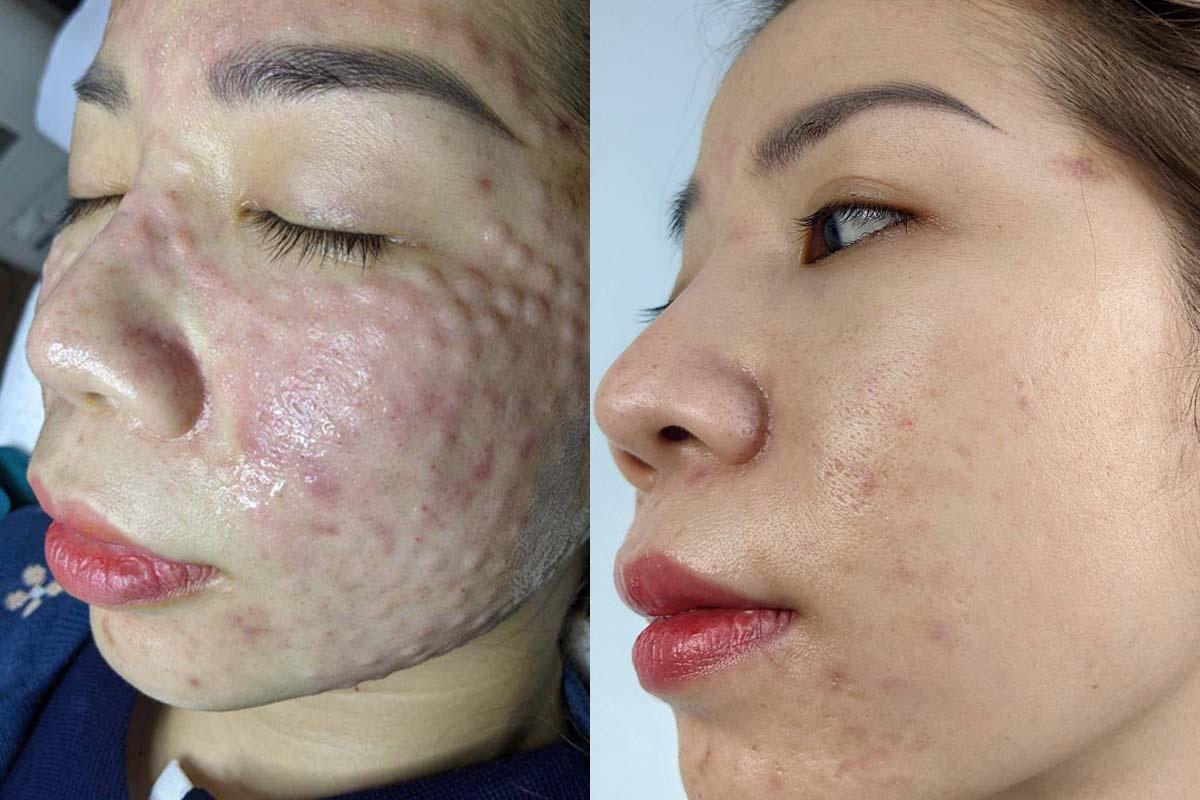 Tiêm meso có tác dụng gì