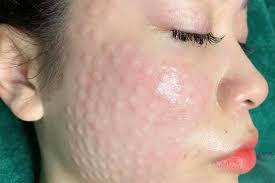 Tiêm meso có tác dụng gì