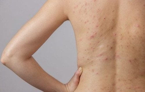 trị viêm nang lông ở chân tại nhà