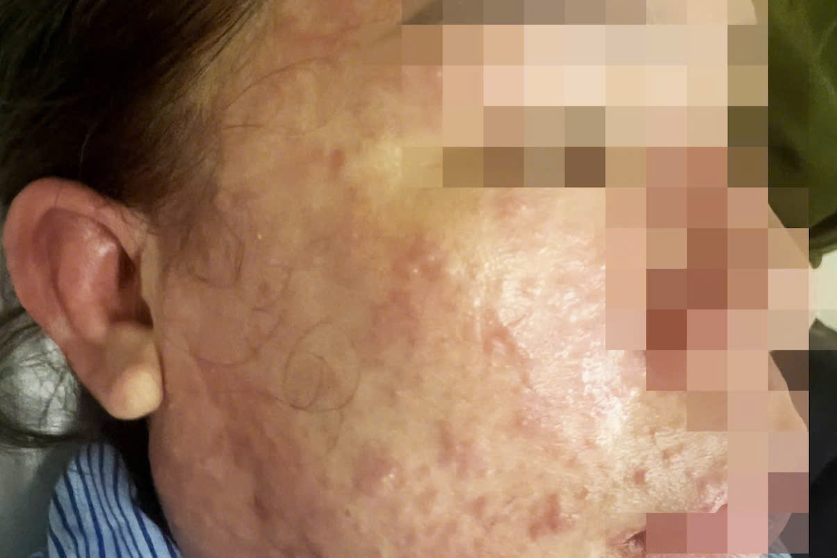 Nguy Kịch Vì Uống “Thuốc Giảm Mỡ Bụng, Collagen” Không Rõ Nguồn Gốc – Cảnh Báo Của Bác Sĩ Da Liễu