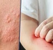 Viêm da cơ địa: Nguyên nhân, triệu chứng và cách điều trị hiệu quả cho ngươi lớn và trẻ em – TS.BS Hiền chia sẻ