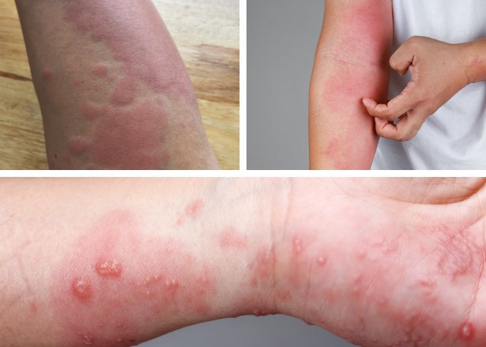 Viêm da tiếp xúc và viêm da cơ địa: Cách phân biệt đơn giản