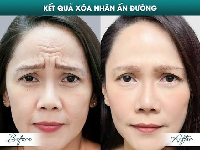 tiêm meso trị nám Hà Nội